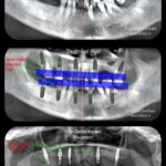 Same Visit Fixed Teeth (SVFT) Radiographs