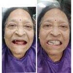 Same Visit Fixed Teeth (SVFT) complete presentation