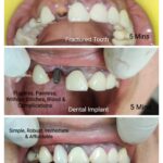 Same Visit Fixed Tooth ( SVFT)