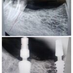 Immediate Dental Implant