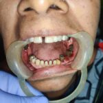 Digital Full Arch Dental Implant Impression Making