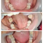 D4 Bone & Same Visit Fixed Teeth (SVFT)
