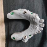 Digital Full Arch Dental Implant 3 d printed models