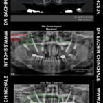 D4 Bone & Same Visit Fixed Teeth (SVFT)