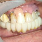 One Piece 12 Unit Dental Implant Monolithic Zirconia