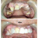 D4 Bone & Same Visit Fixed Teeth (SVFT)