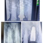 Deep Bite & Immediate Dental Implant