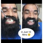 Same Visit Fixed Teeth (SVFT)