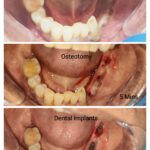 30 Mins and 5 Dental Implants…