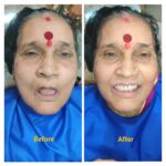 Full Mouth Dental Implant and Fixed Teeth