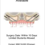 Live Zygoma Dental Implant Surgical Placement