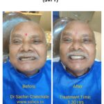 75 year old male received the same Visit Implant Fixed Teeth (SVFT )