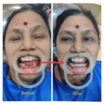 70 Year Women Received Same Visit Fixed Implant Teeth (SVFT)