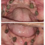 *Full Mouth Dental Implant Digital Impression* Done Today