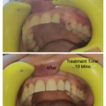 Missing Tooth to Fixed Tooth