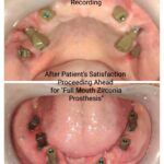 Full Mouth Dental Implants Digital Impression Recording