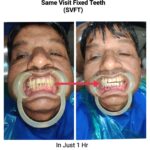 Bad Teeth to The Best Healthy Teeth