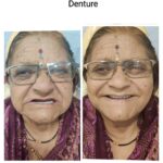 Complete Removable Prosthesis: Challenging Case