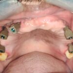 Full Arch Dental Implant Digital Impression