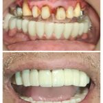 Full Arch Sectional Zirconia Prosthesis
