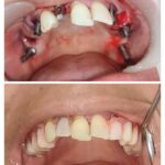 Same Visit Fixed Tooth (SVFT)