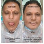 Bilateral Zygoma PterygoMaxillary, Nerve Bypass Same Visit Fixed Teeth (SVFT)