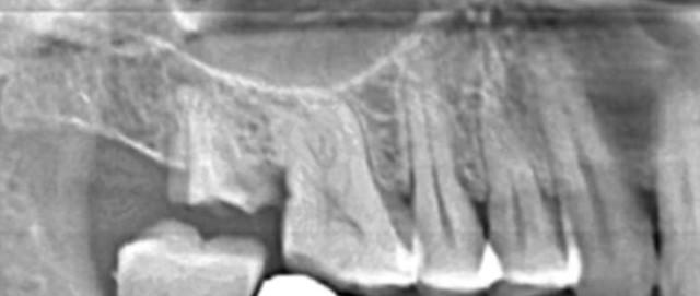 Can an immediate implant be done in this case ?