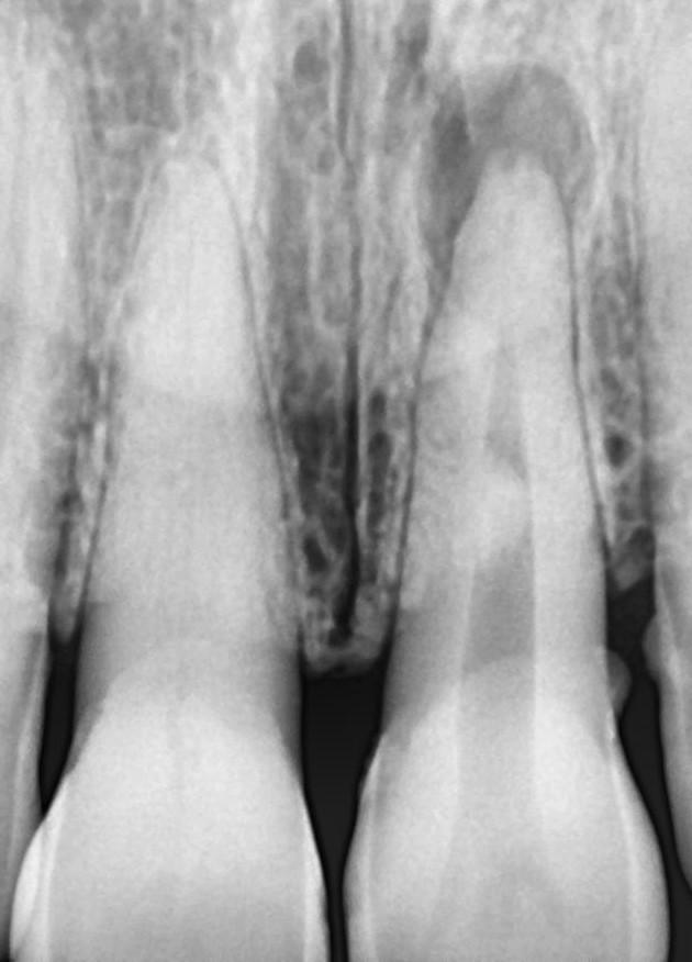 Opacity in root canal space