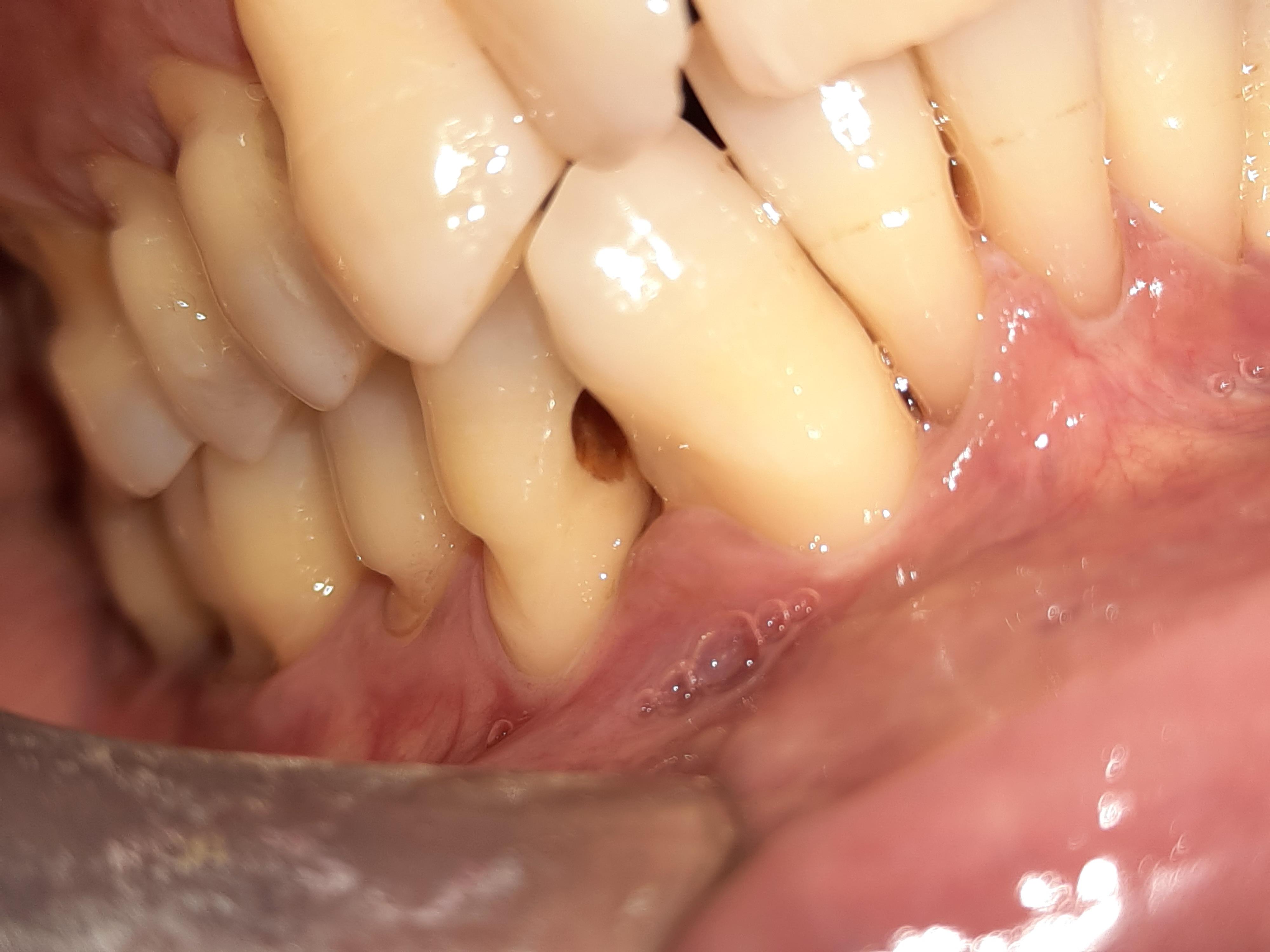 Root Caries- Frequently overlooked
