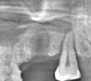 Should I place implant in this UR second molar