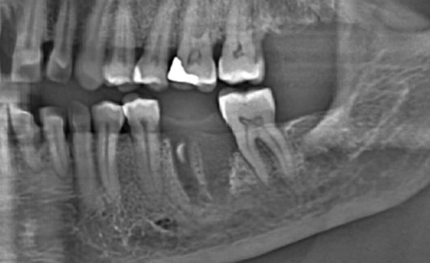 is immediate implant possible in this lower left first molar ?