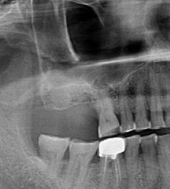What best can be done for this upper right second molar ?