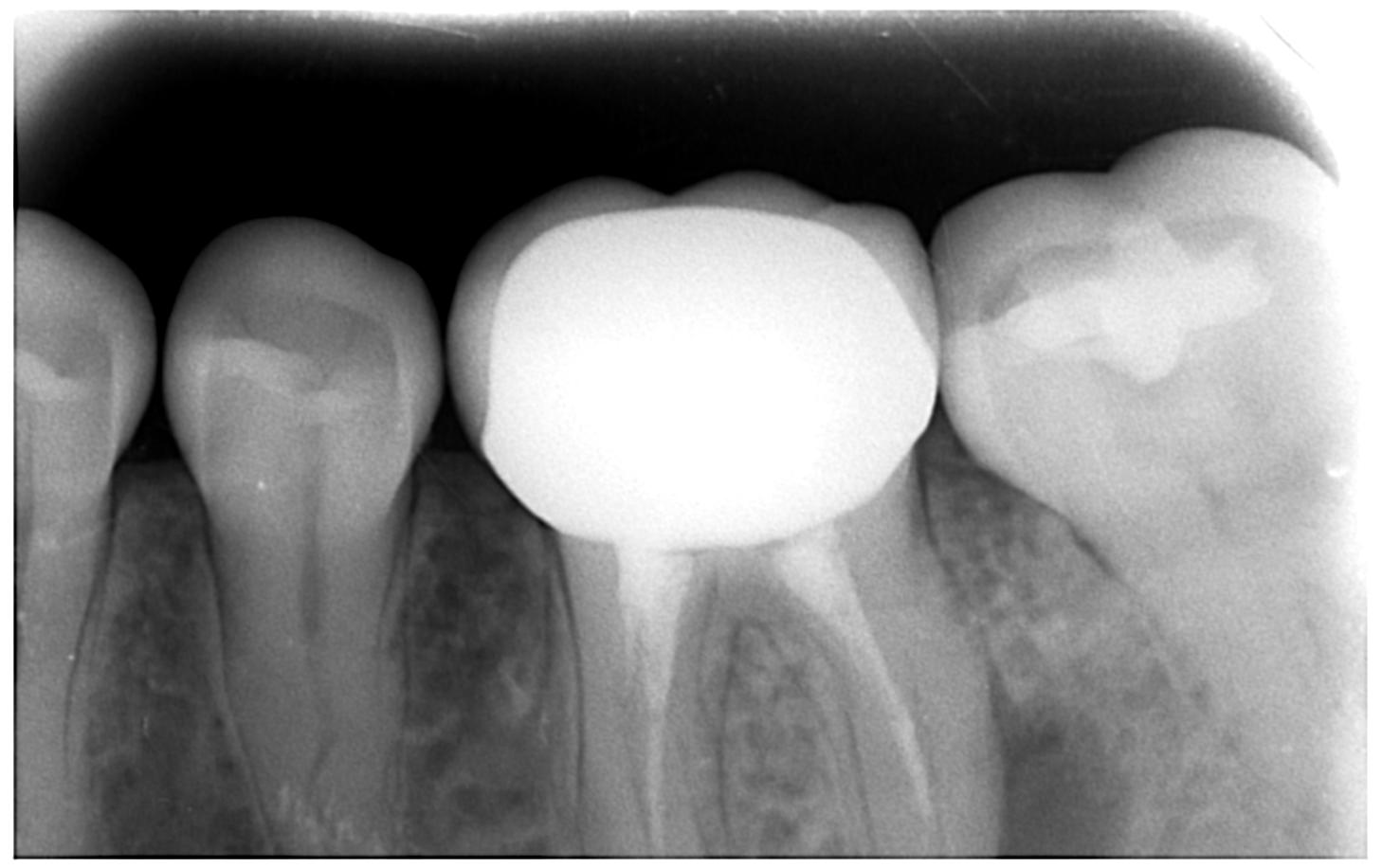 Lateral periapical lesion . What is the prognosis ?