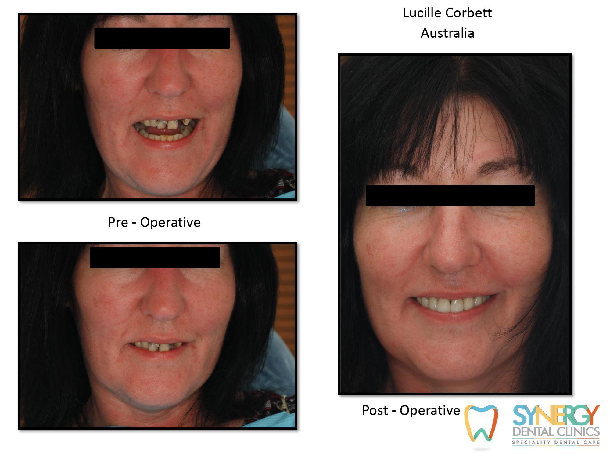 case done by synerg dental clinic mumbai – Patient Lucille Corbett – Australia