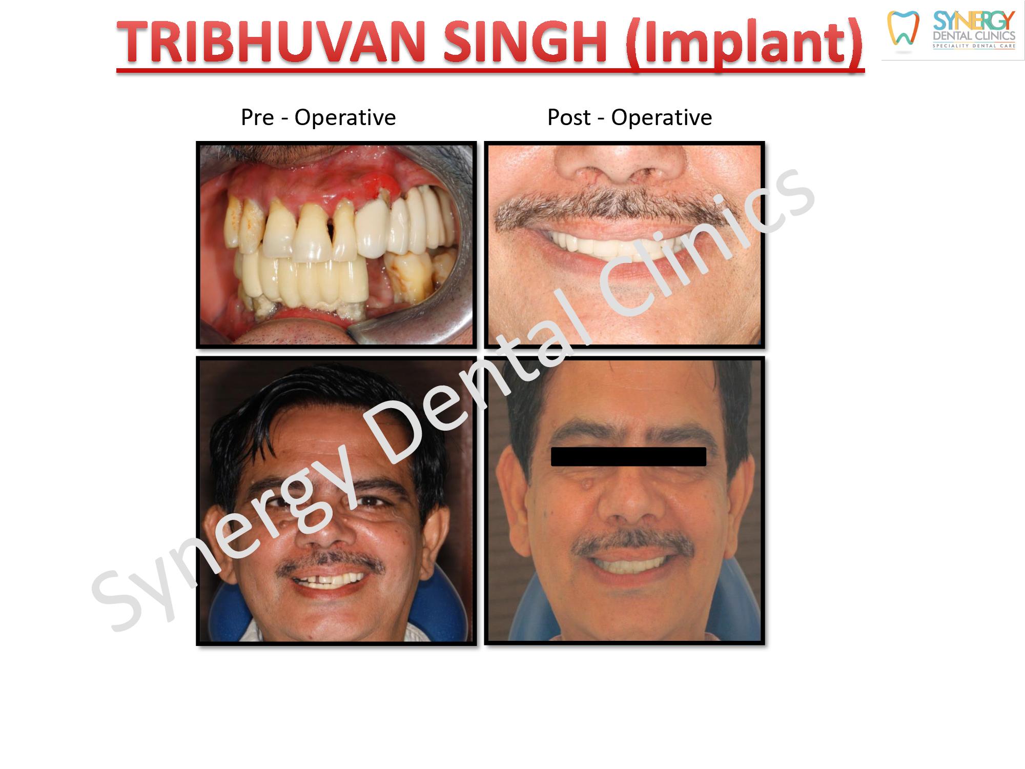 Dental Implants -Synergy Dental Clinic- Tribhuvan Singh