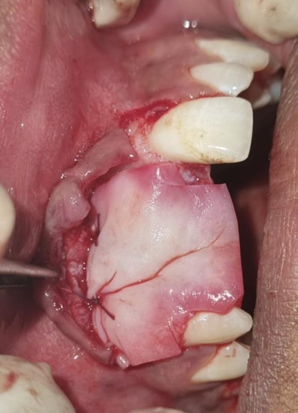 Buccal Defect Addressed with Indian Allograft & Soft Tissue Matrix