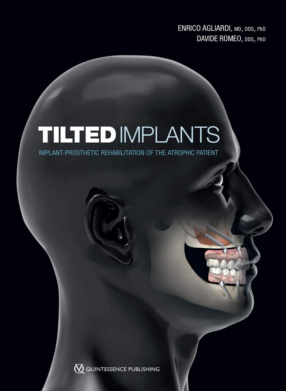 A book on TILTED IMPLANTS