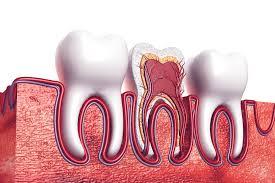 When to Visit a Root Canal Specialist in London