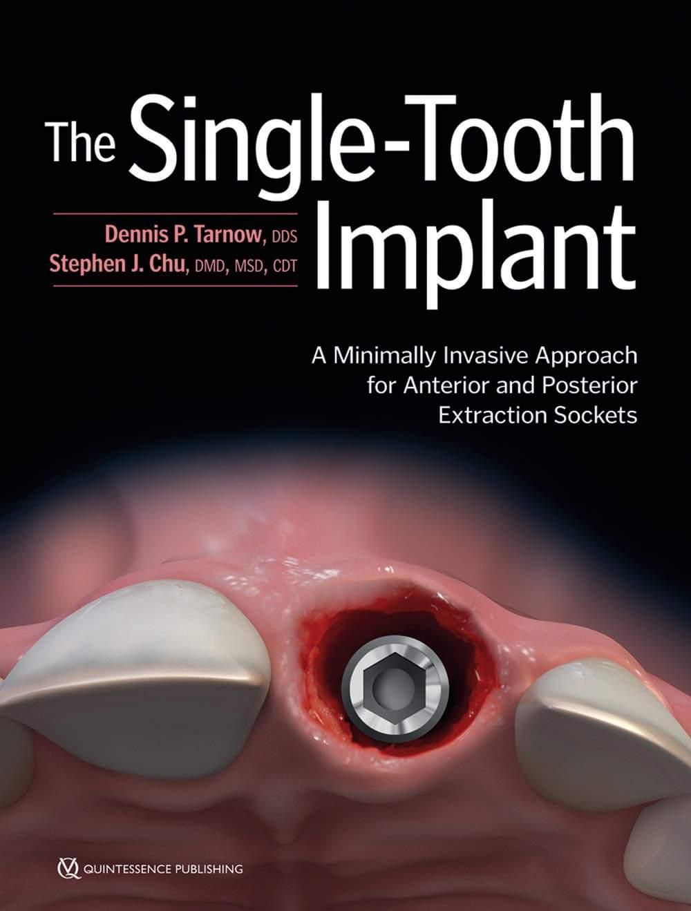 A book on SINGLE TOOTH IMPLANT