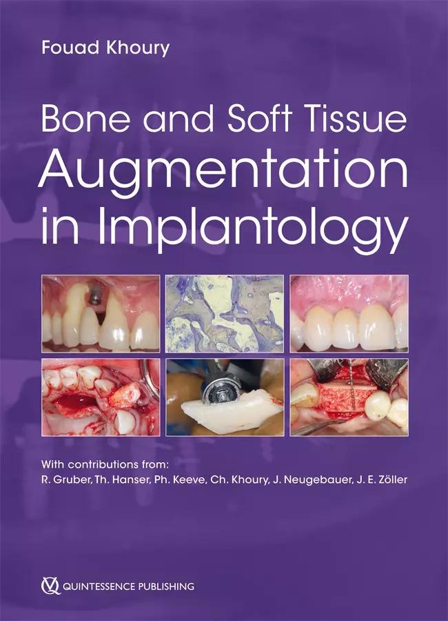 A book on BONE & SOFT TISSUE AUGMENTATION in IMPLANTOLOGY