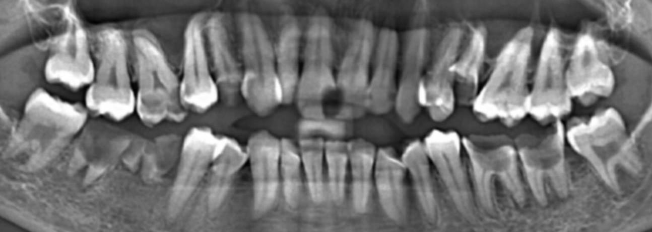 What kind of smile redesigning can be done for this case ?