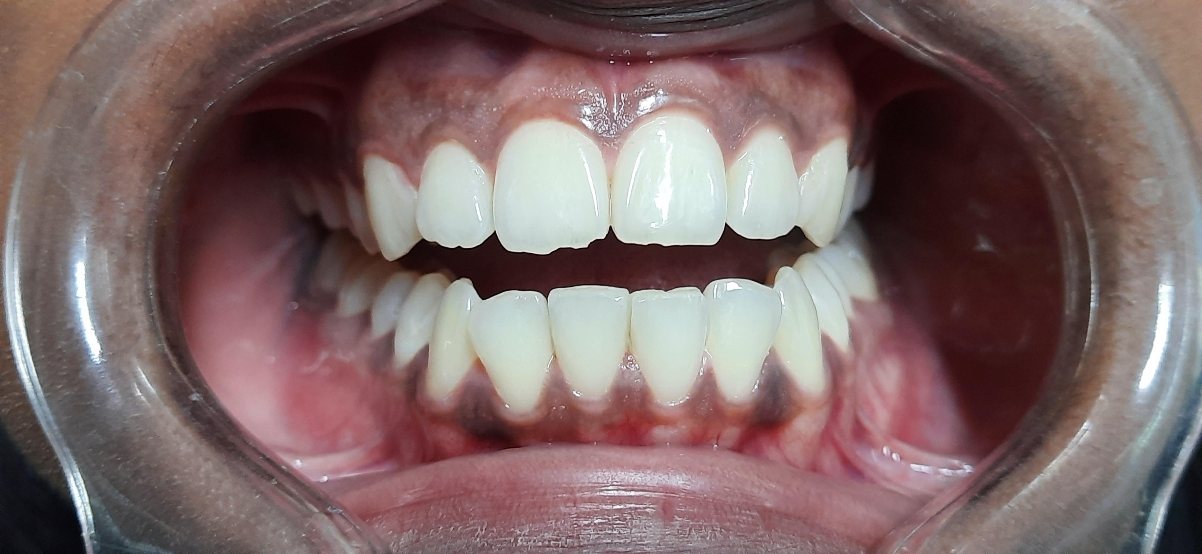 Very minor chipping of enamel. How to restore ?