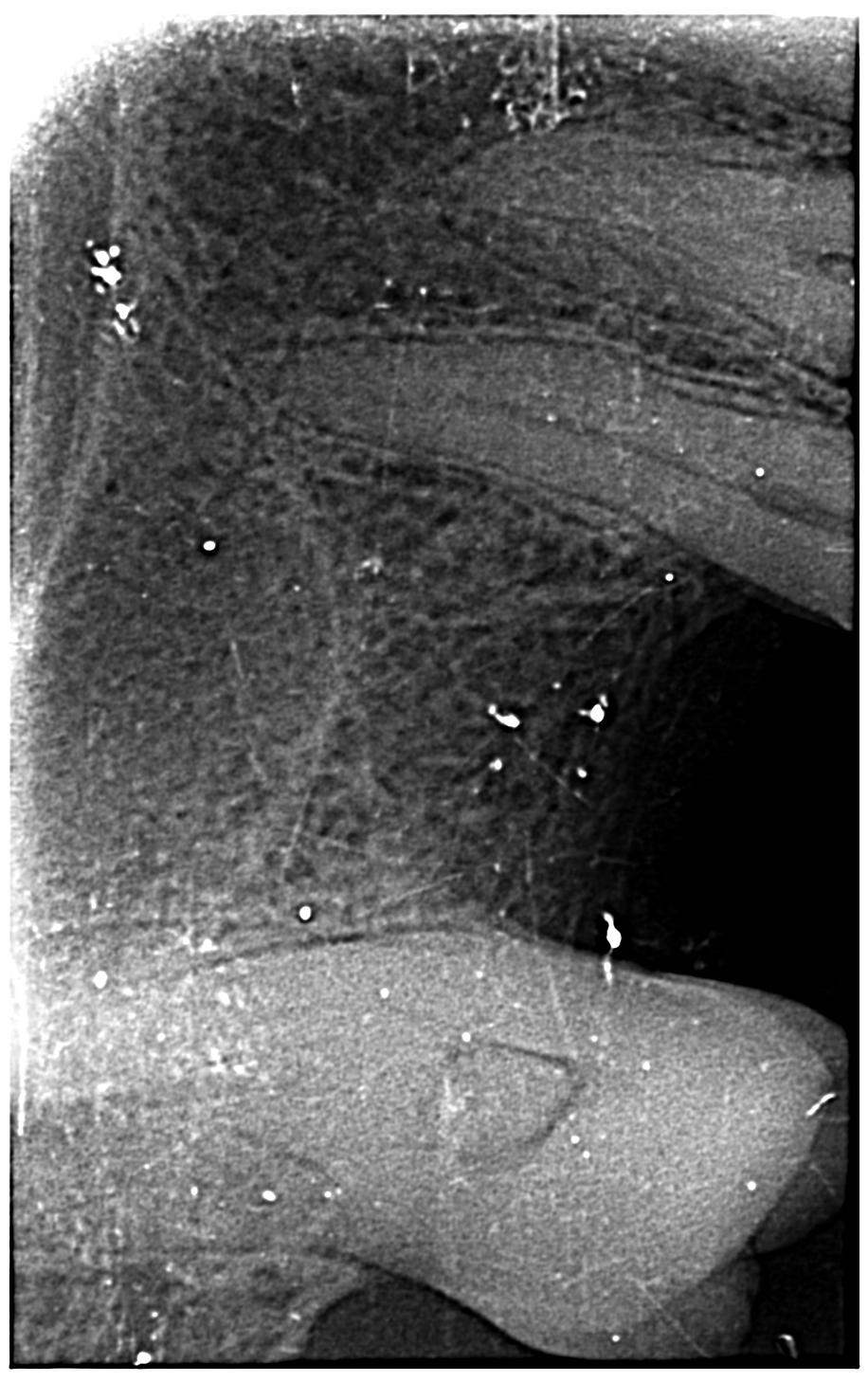 Help required in implant placement of upper right first molar