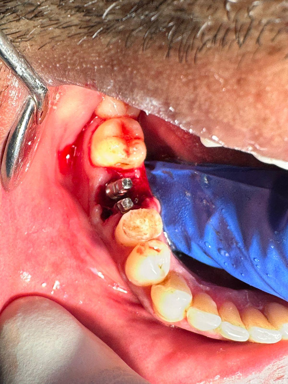 Lingual Cortical Engagement